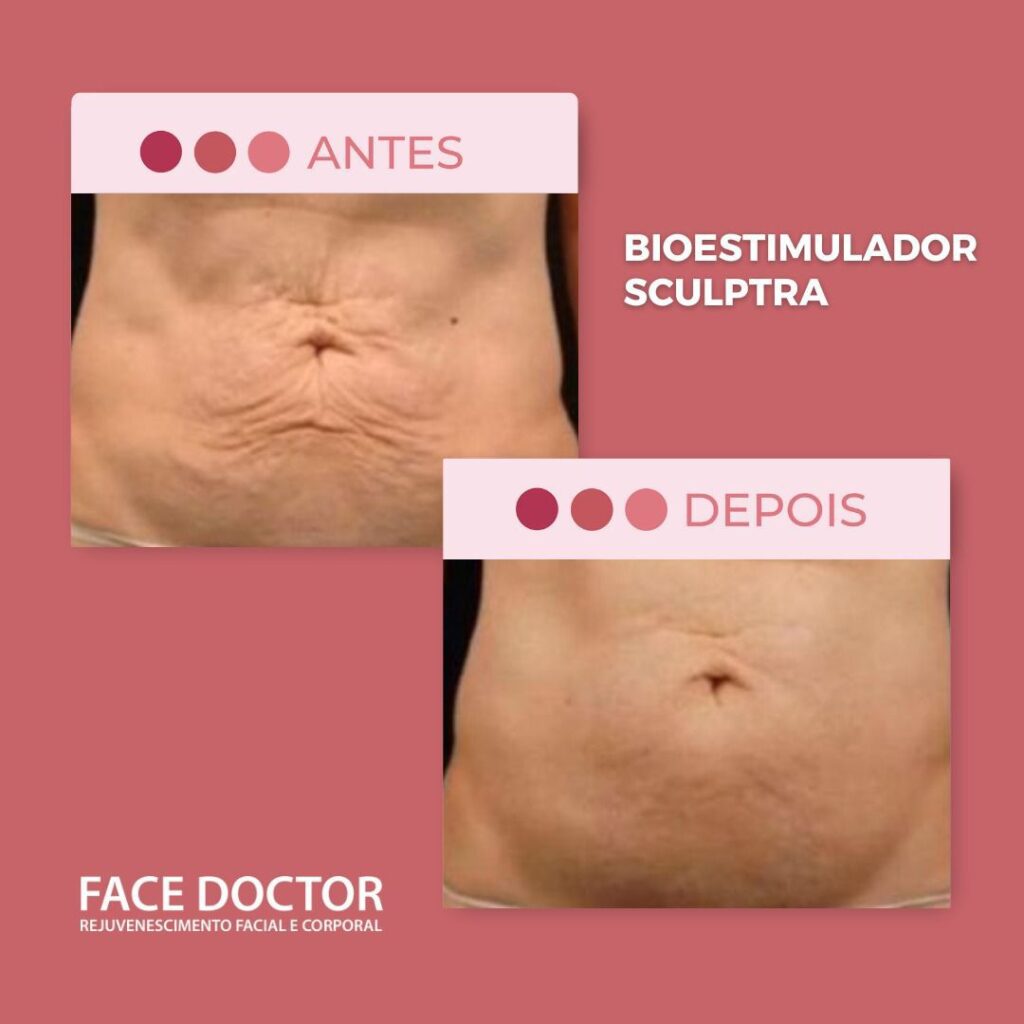 Bioestimulador Sculptra