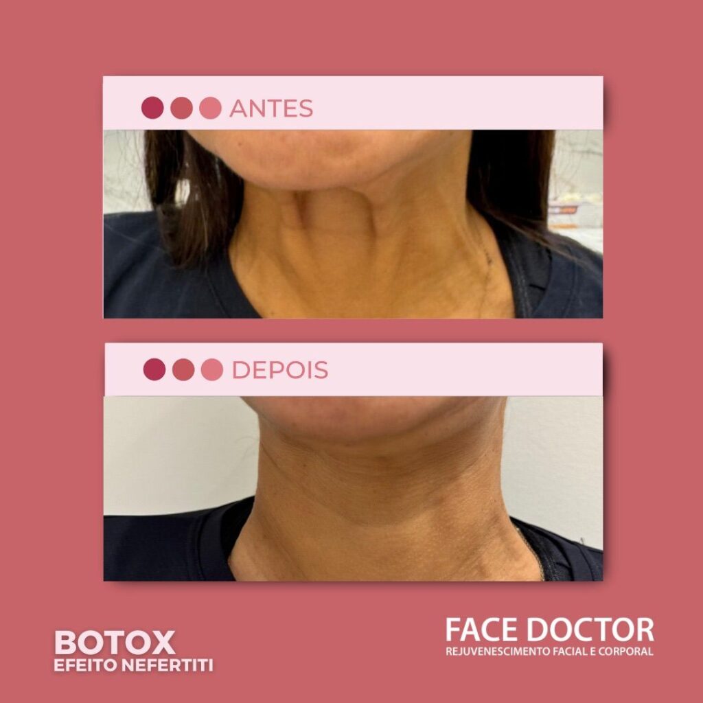 Botox Efeito Nefertiti