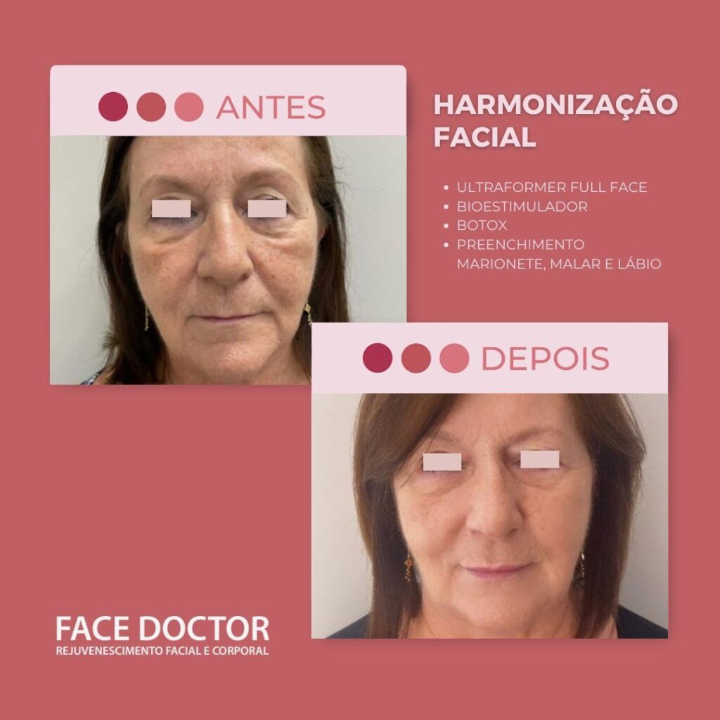 Harmonização Facial