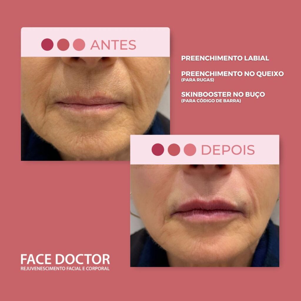 Preenchimento Labial.jpg + Queixo