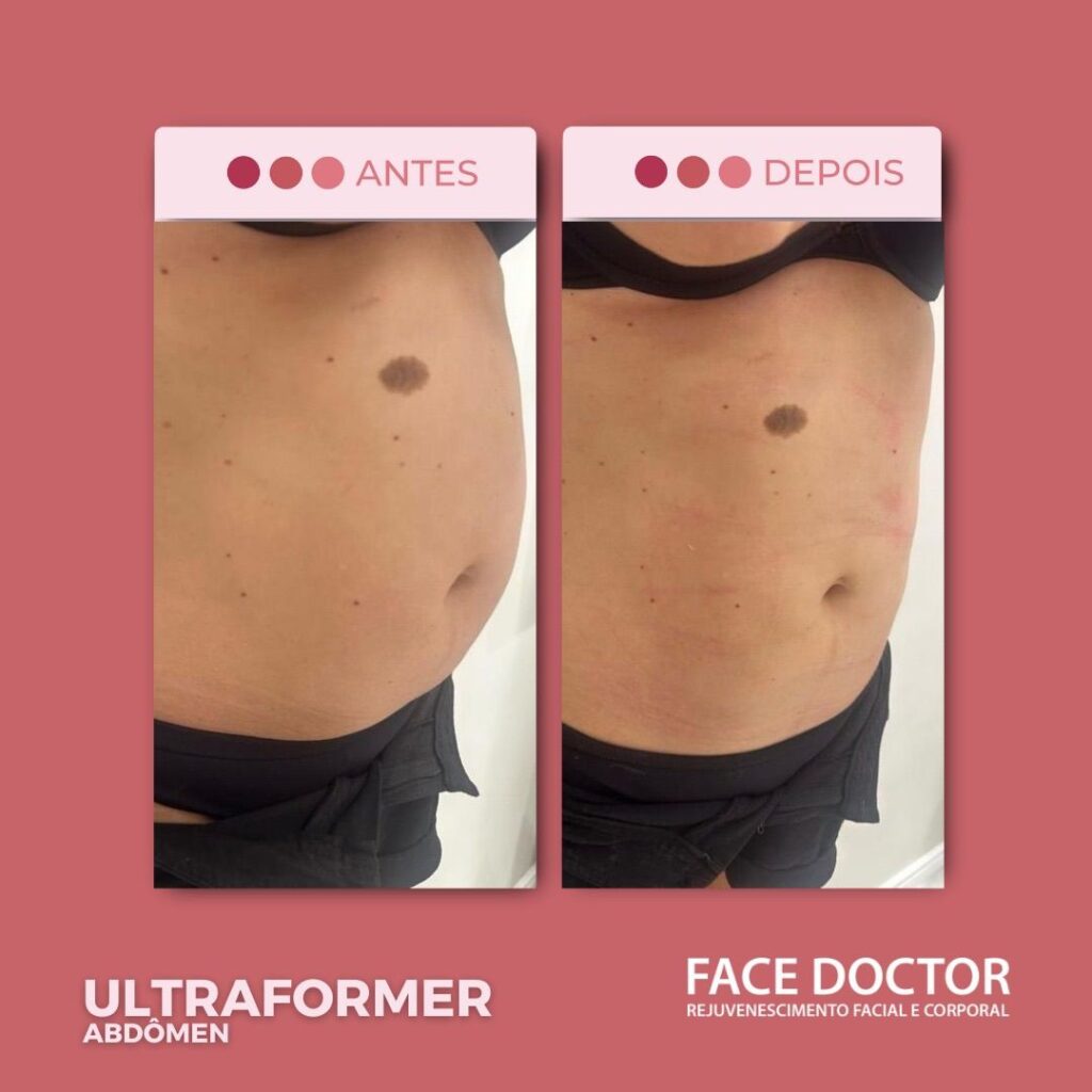 UF Abdomen 2